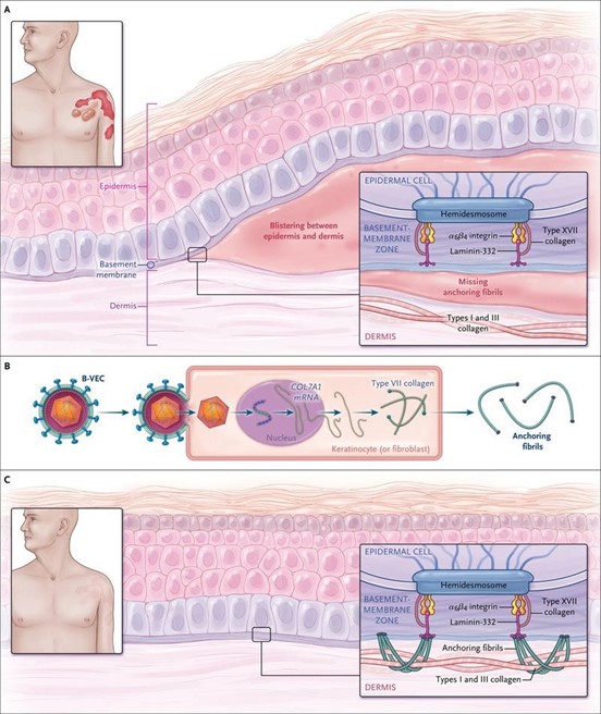 قش-ژن-درمانی-در-اپیدرمولیزر-بولوزا-دیستروفیک