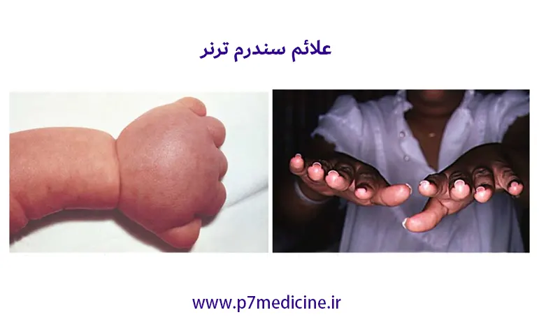 علائم سندرم ترنر