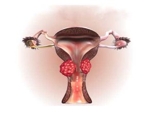 آیا سرطان رحم ارثی است؟