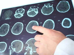 درمان آتروفی مخچه