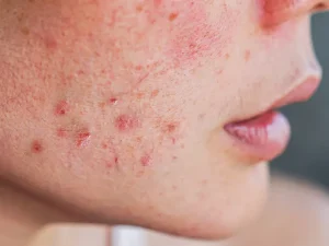 نقش ژنتیک در بیماری لوپوس