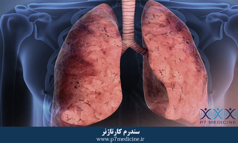 سندرم کارتاژنر سندرم کارتاژنر