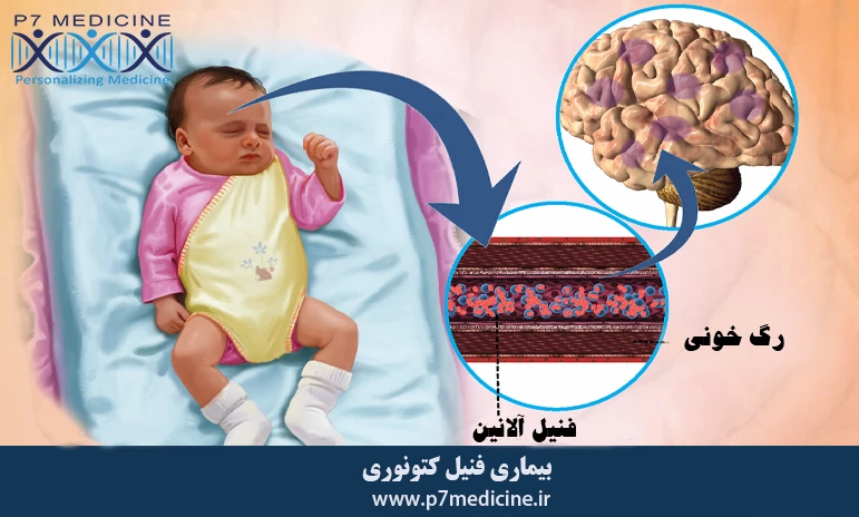 بیماری فنیل کتونوری