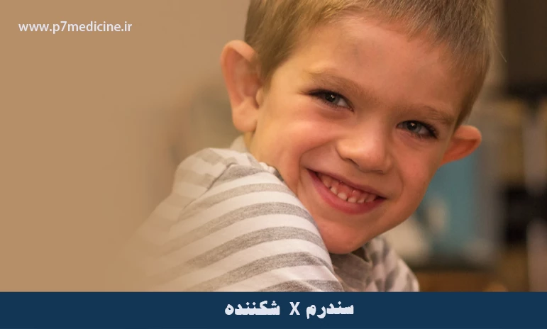 سندرم X شکننده
