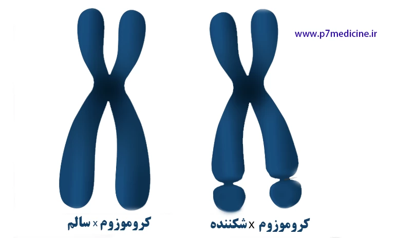 علائم سندرم x شکننده
