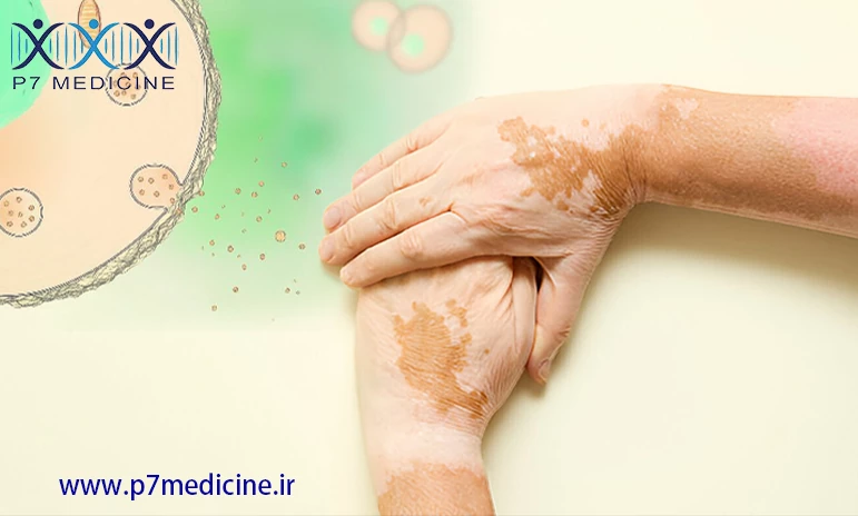 روند انجام سلول‌درمانی ویتیلیگو