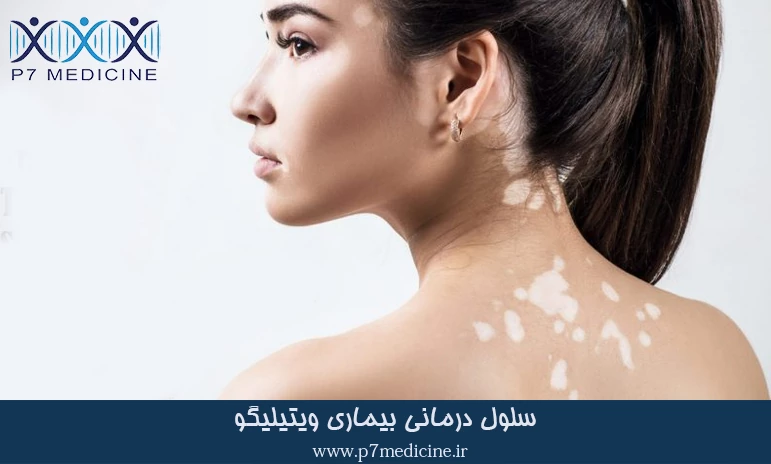 سلول ‌درمانی بیماری ویتیلیگو