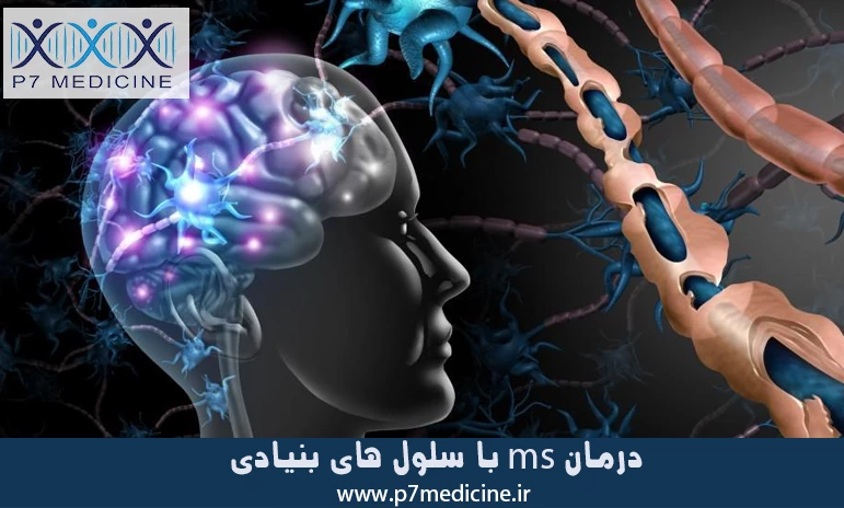 درمان ms با سلول های بنیادی